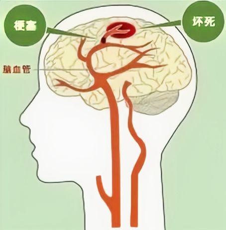 大脑的“清障车”：脑梗死取栓手术